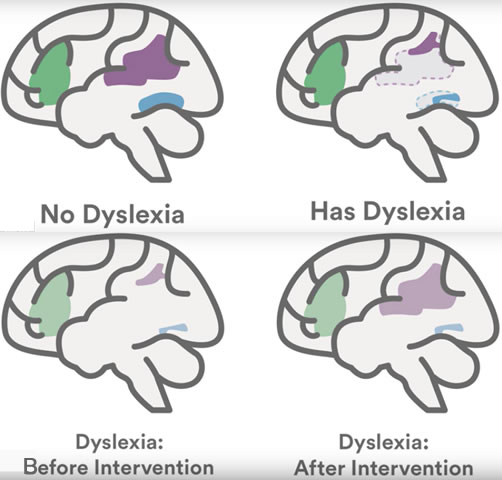 Brain Imaging of people with Dyslexia before and after intervention shows brain plasticity and gains in reading